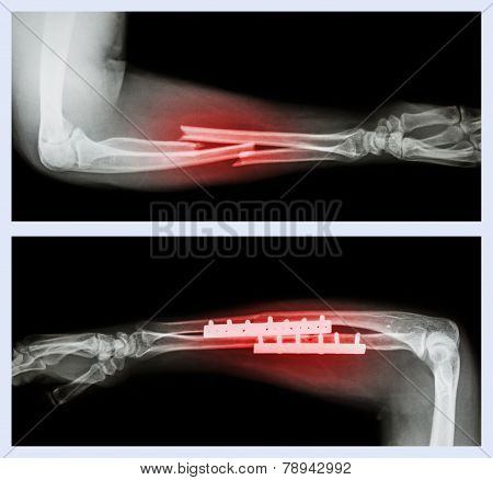 Fracture ulnar and radius (Forearm bone)