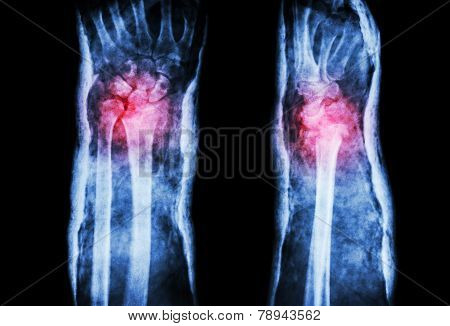 Fracture Distal Radius (colles' Fracture) And Cast