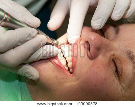 Dentis making dental filling on front tooth