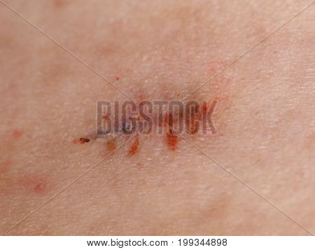 Surgical Wound Stitches Removed