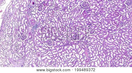 Arteriolar hyaline degeneration of kidney of a human, highly detailed segment of panorama. Photomicrograph as seen under the microscope, 10x zoom.