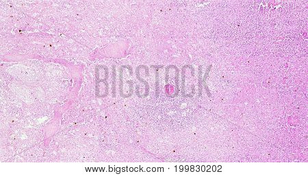 Histology of human tissue, show spleen infarction as seen under the microscope, 10x zoom.