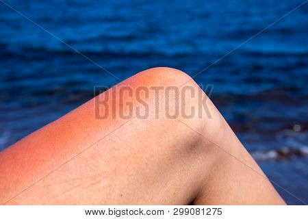 Woman Leg With Red Sunburn Skin On Blue Sea Background. Sun Burned Skin Redness And Irritation. Dang