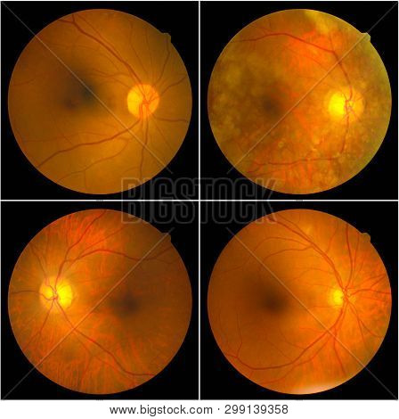 Collection Of Retinal Image  Of The Patient Taken With Retinal Photography Machine.