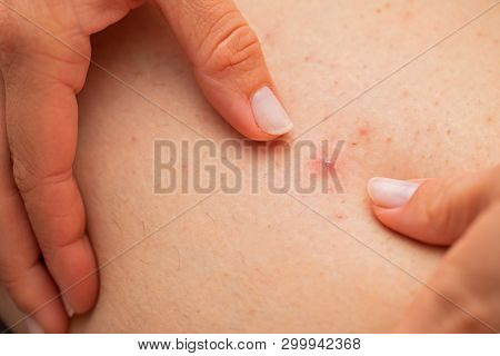 Close Up Picture Of Folliculitis On Female Skin - Hands Squeezing The Infected Follicle, Painful