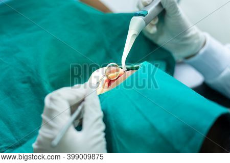 Close Up Hand Dentist Check Teeth Milk Tooth Of Child Is Sitting In A Dental Chair Inspecting Her Te