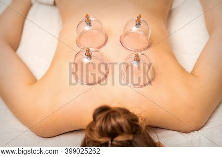 Vacuum Cups Of Medical Cupping Therapy On Woman Back, Close Up, Chinese Medicine.